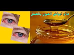 فوائد العسل لجفاف العين