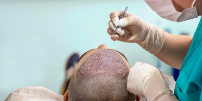 أطباء زراعة الشعر في اسطنبول