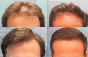 نتائج عملية زراعة الشعر بعد 3 شهور