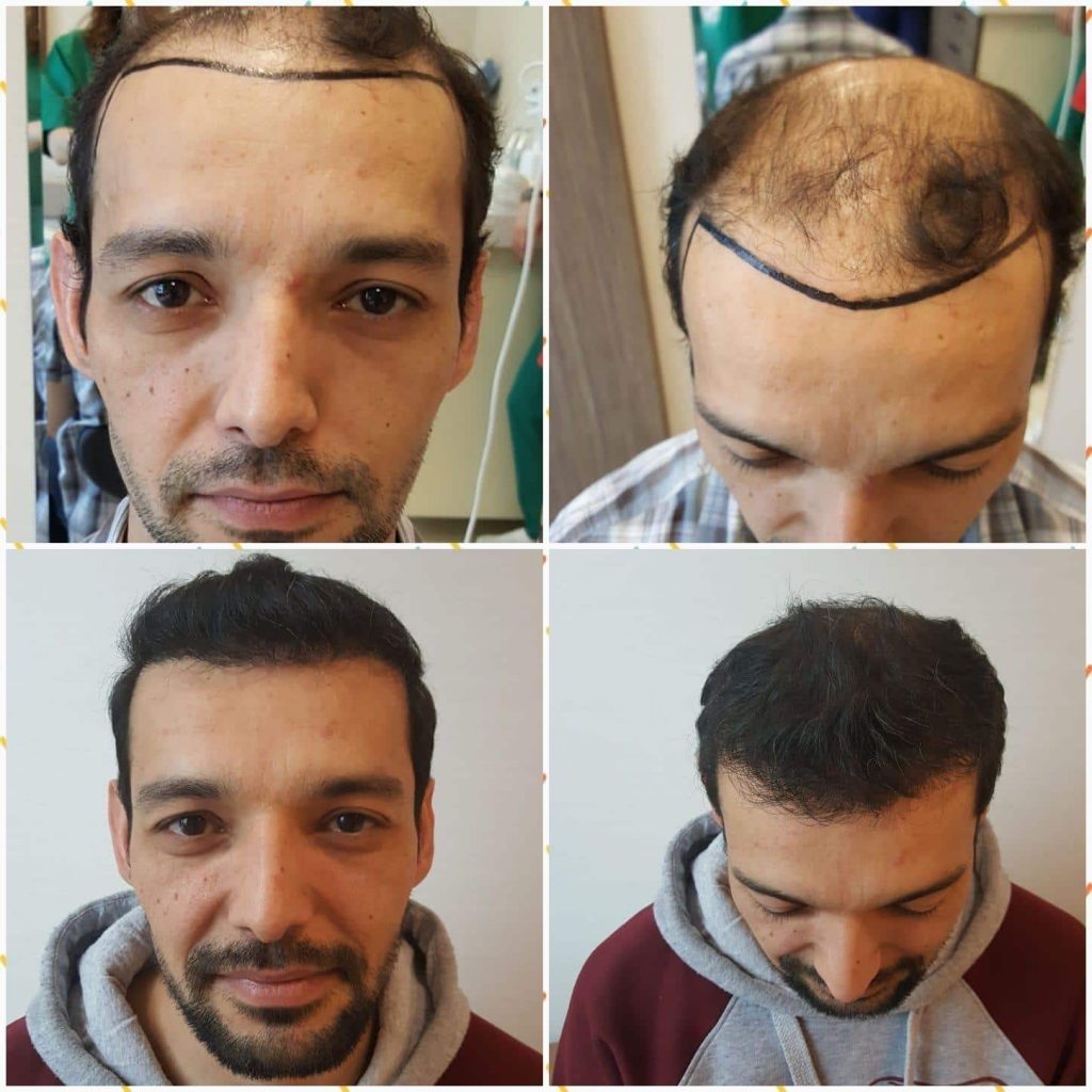 زراعة الشعر في اسطنبول السعر